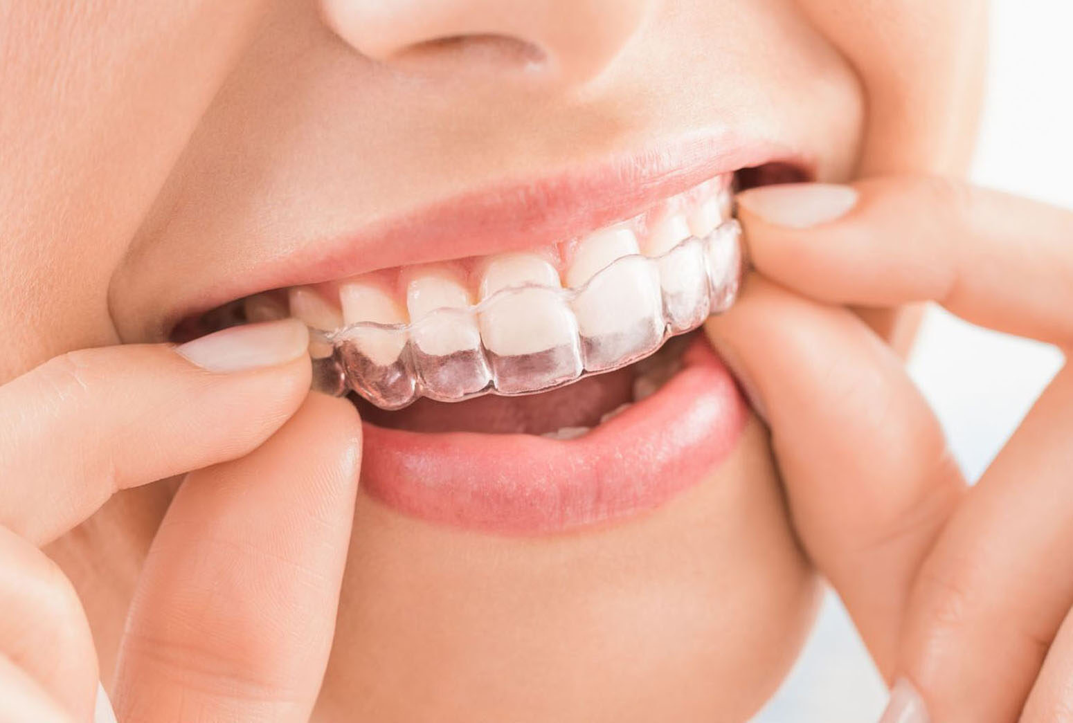 Chacon Orthodontics - Clear Aligners