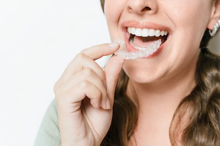 Clear Aligners Near Me