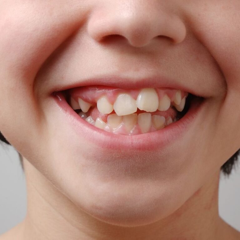 signs that you need braces