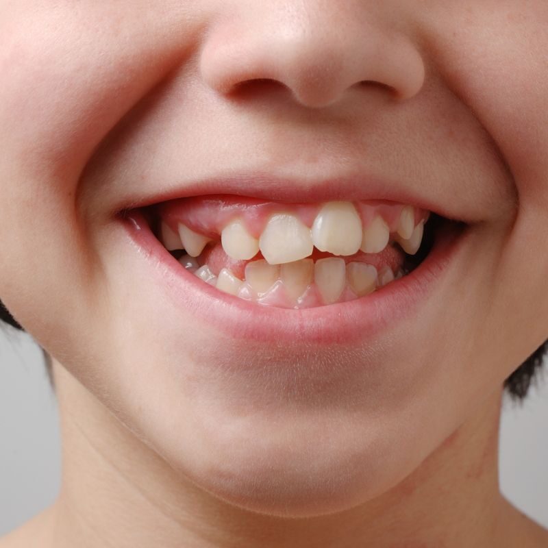 signs that you need braces