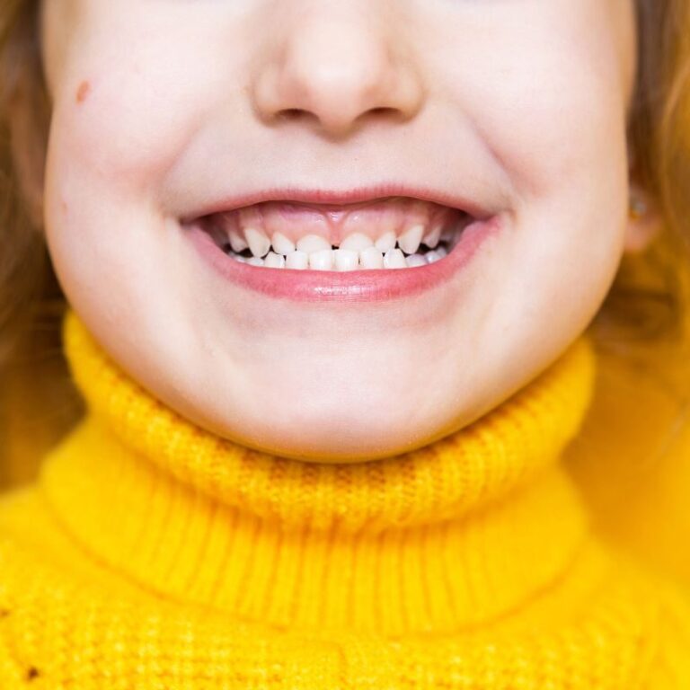 overbite vs underbite