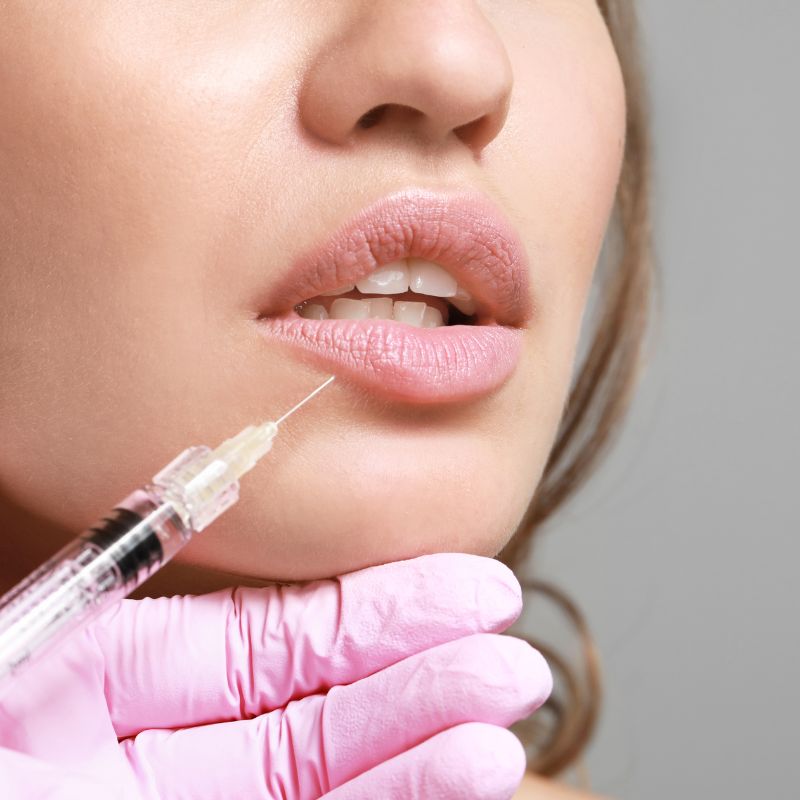 Lip Fillers